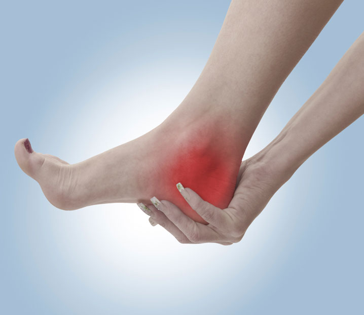 Santa Rosa Plantar Fasciitis Chiropractors