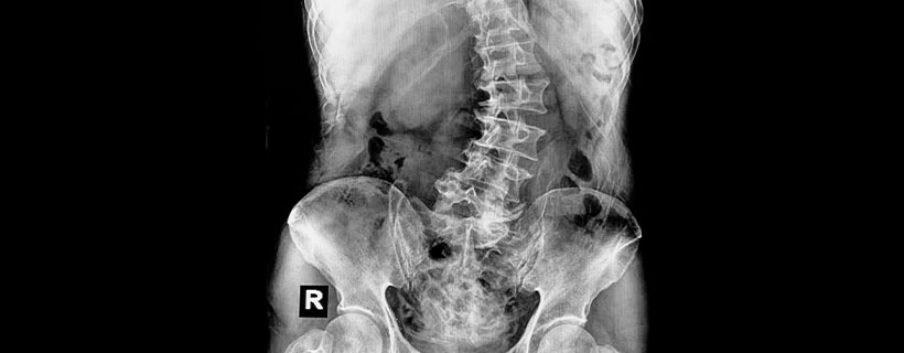 patient suffering from scoliosis in need of chiropractor in Santa Rosa
