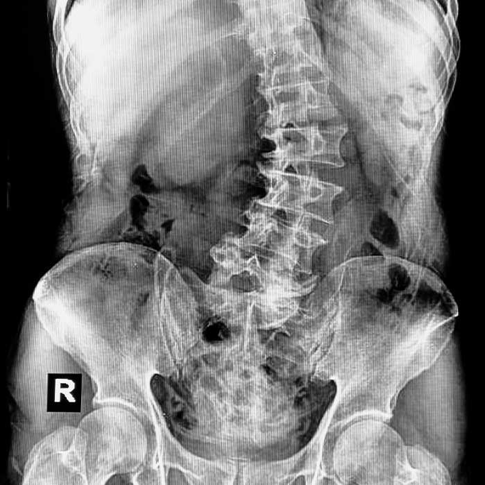 Scoliosis chiropractor in Santa Rosa